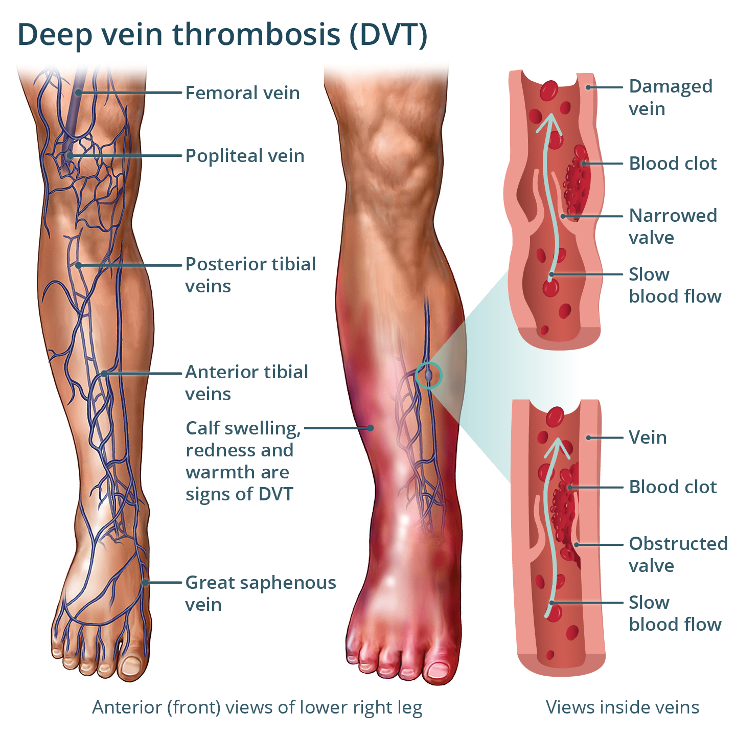 Deep Vein Thrombosis (DVT)
