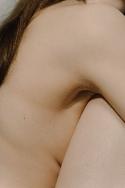 7 Common Misdiagnoses for Hidradenitis Suppurativa (HS)
