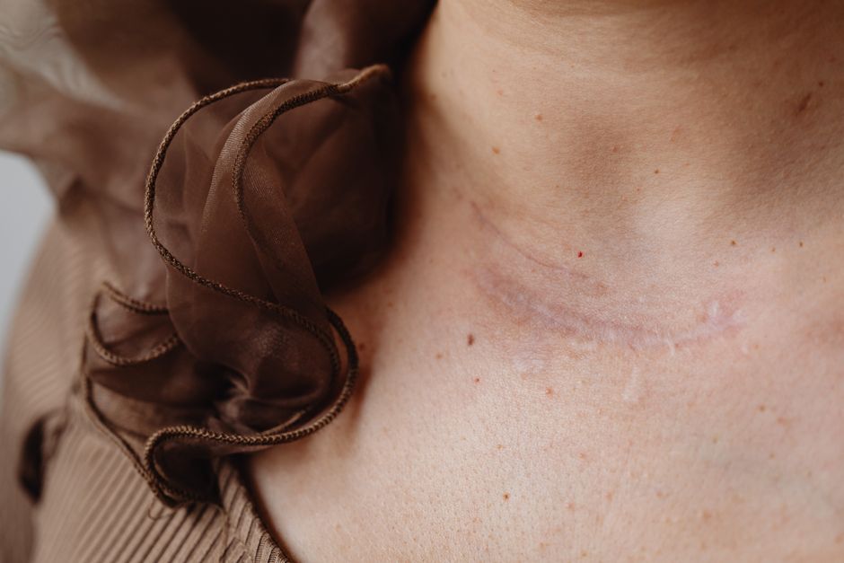 A Small Lump in Her Neck Led to 2 Rare Tumors and a 24-Hour Surgery