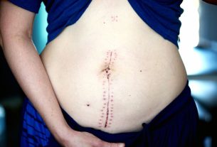 A Small Lump in Her Neck Led to 2 Rare Tumors and a 24-Hour Surgery