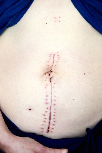 A Small Lump in Her Neck Led to 2 Rare Tumors and a 24-Hour Surgery