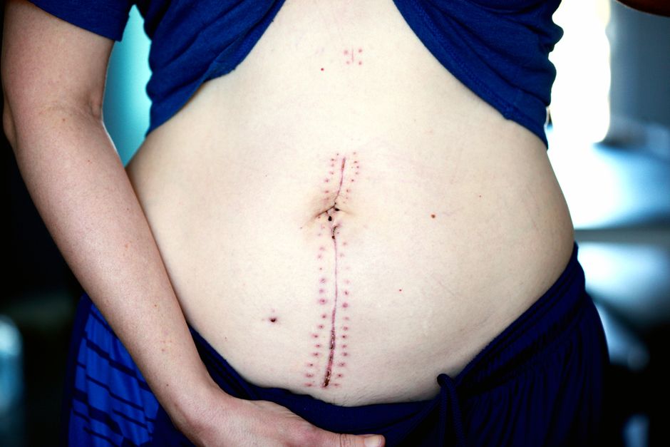 A Small Lump in Her Neck Led to 2 Rare Tumors and a 24-Hour Surgery