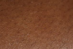 7 Places on the Body That Hidradenitis Suppurativa Can Appear