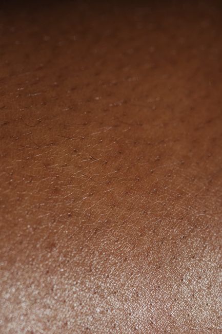 7 Places on the Body That Hidradenitis Suppurativa Can Appear