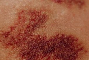 Hickey Stages: Understanding and Managing Love Bites Effectively