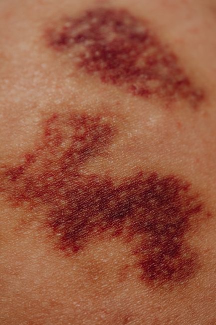 Hickey Stages: Understanding and Managing Love Bites Effectively